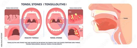 Tonsil Stones Crypts Viral Virus Gland Strep Throa Wallsheaven Rumruay