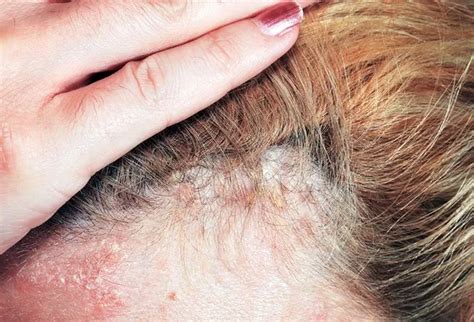 What Is Scalp Psoriasis Causes Symptoms And Treatment