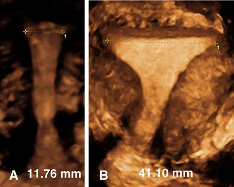 A Multicenter Study Assessing Uterine Cavity Width In Over Nulliparous Women Seeking IUD