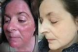Skincare And Makeup For Rosacea Images