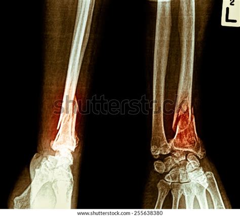 Film Xray Wrist Show Fracture Distal Foto Stock 255638380 Shutterstock