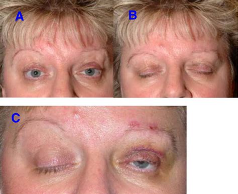 Patient After Bilateral Frontalis Suspension Surgery The Eyes Can Be