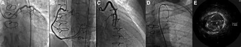 Mri Induced Stent Dislodgment Soon After Left Main