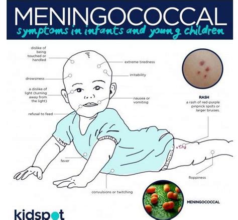 Meningococcal Disease Dr Sam On Symptoms Treatment Vaccines Kidspot