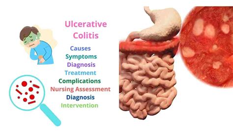 Ulcerative Colitis Causes Symptoms Diagnosis Treatment Complications
