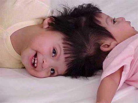 Rapid Prototyping Helps Separate Conjoined Twins