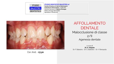 Studio Dentistico Balestro Malocclusione Di Classe
