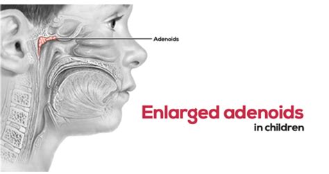 Enlarged Adenoids In Children Find The Facts Too Kind Studio