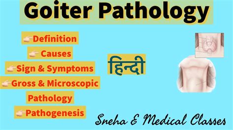 Goiter Hindi Pathogenesis Gross And Microscopic Pathology