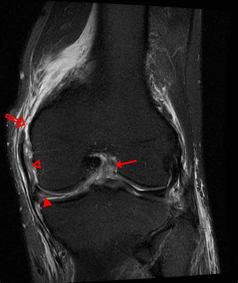 Medial Supporting Structures Of The Knee With Emphasis On The Medial