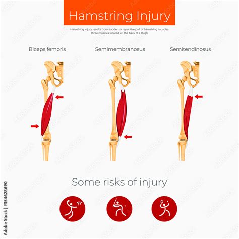 Hamstring Injury Anatomy Scheme Poster Stock Vector Adobe Stock