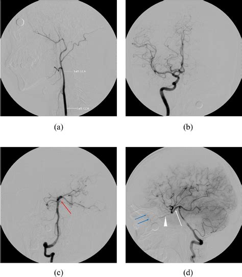 Figure From Unilateral Agenesis Of Internal Carotid Artery Associated With Superior Cerebellar
