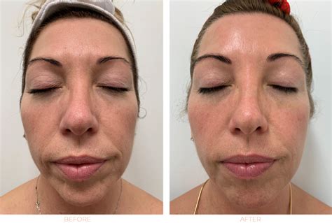 Hifu Face Lift Before And After Evolve Private Aesthetics Clinic Bolton