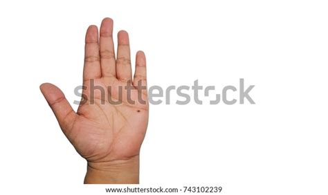 Mole On A Left Hand Of Asian Woman Isolated On White Background