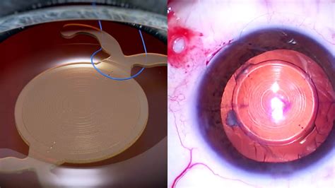 Dislocated Toric Multifocal Intraocular Lens 3d Animation And Step By Step Eye Surgery Youtube