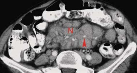 Mesenteric Small Bowel Radiology Key