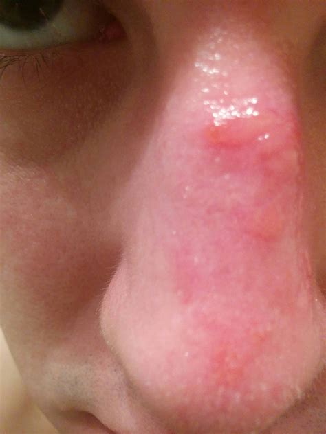 Skin Concern Sunburn Blisters On Nose Skincareaddiction