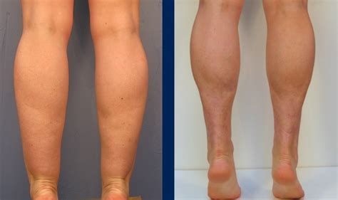 How To Get Rid Of Cankles Fast → Get Skinny Ankles Without Surgery