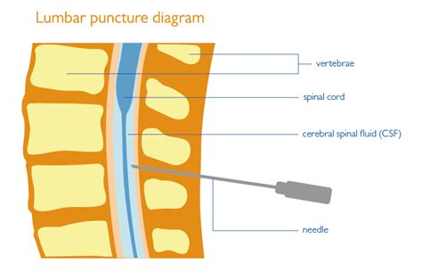 Lumbar Puncture Fact Sheet Health Information Brain And Spine
