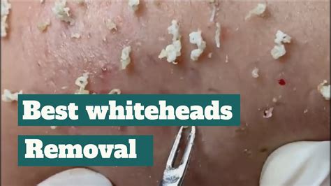 Best Whiteheads Removal Skin Allergies To Creams Youtube