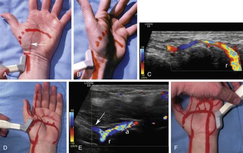 Assessment Of Upper Extremity Arterial Disease Radiology Key