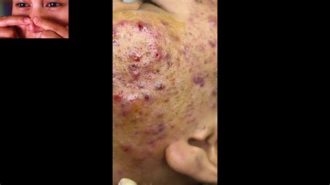 Infected Skin Tons Of Blackheads Whiteheads And Cysts All Over Face