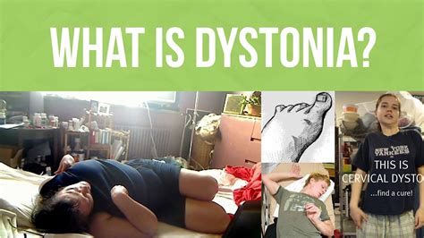 What Is Dystonia Dystonia Awareness Week Youtube