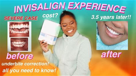 How Invisalign Changed My Life Severe Case Invisalign Journey Before