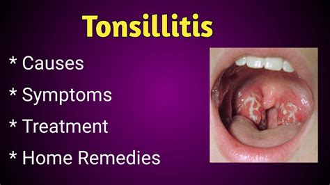 Tonsillitis Causes Symptoms And Treatment Youtube
