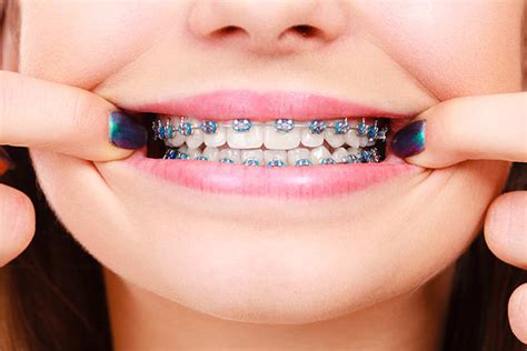 Colourful Elastics Help To Make Braces Fun Langley Orthodontist