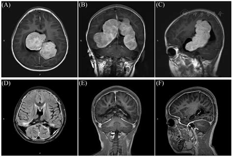 Staging Surgery For Intraventricular Bilateral Giant Rosai Dorfman