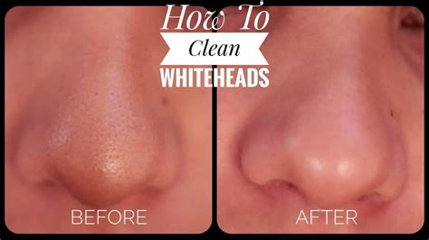 How To Get Rid Of Whiteheads On Jawline Home Remedies Over The Counter
