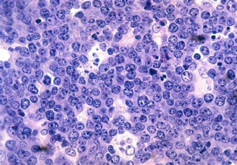 The Starry Sky Pattern Of Burkitts Lymphoma The Tumour Cells Of B