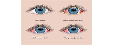 How To Care For Your Child With A Conjunctivitis Sidra Medicine