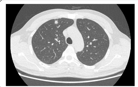 Ct Image Showing A Solid Pulmonary Nodule In The Right Upper Lobe