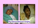 Photos of Fibroid Removal Surgery Recovery