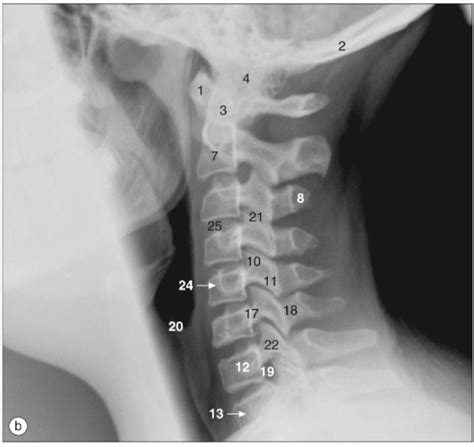Cervical Spine Lateral Radiograph Diagram Quizlet