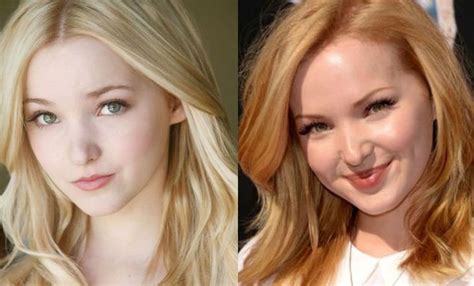 Dove Cameron Plastic Before And After Surgery 14 Celebrity Plastic Surgery Online