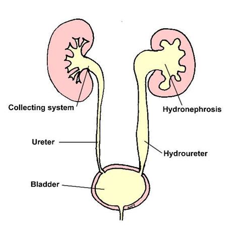 Hydronephrosis Kidney Chat