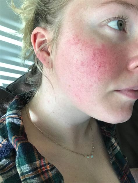 Rosacea I Dont Know Its Not Itchy Or Painful Just Red On Both
