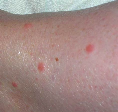 Bed Bug Bites Beds Bed Bugs And Pictures