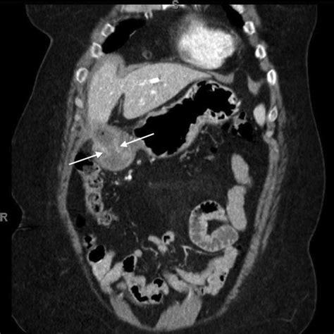 Ct Scan Showing A Fistulous Communication Between The Gallbladder And