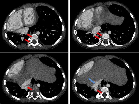 Frontiers A Case Of Rare Pulmonary Sequestration Complicated With