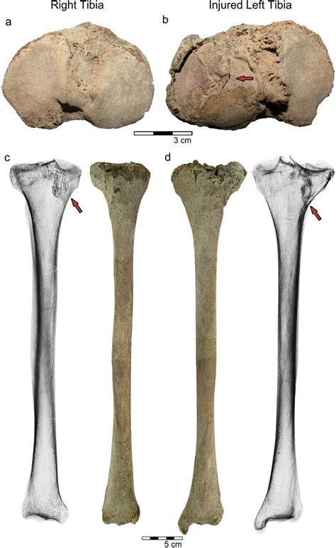 Comparison Between The Right Tibia Left Column And The Left Tibia