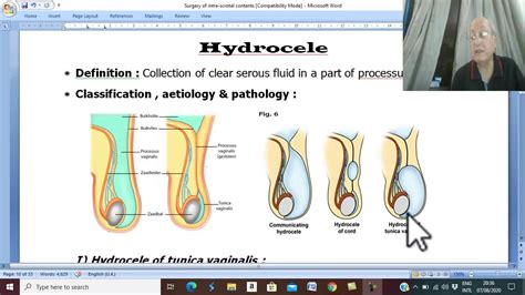 Surgery Of Testis And Scrotum In English 4 Hydrocele Part 1 By Dr Wahdan Youtube