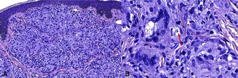 Histopathologic Findings A Numerous Dense Sarcoidal Type Granulomas
