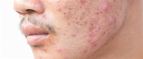 It's an effective treatment, particularly when used in combination with antibiotics. Health Tip: Recognize a Bad Reaction to Acne Medication ...