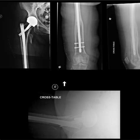 Postoperative Ap And Lateral Radiographs Of The Right Hip And Femur
