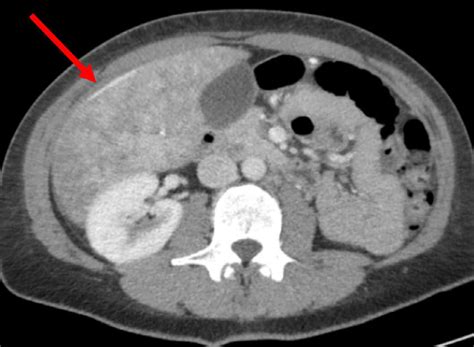 Early Phase Contrast Enhanced Ct Scan Of The Liver Showing