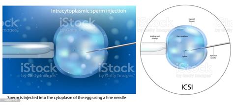 The Procedure Of Intracytoplasmic Sperm Injection Icsi Artificial